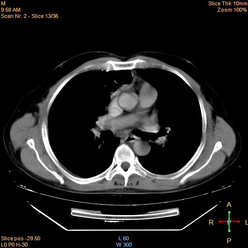 File:Bronchogenic carcinoma with superior vena caval invasion (Radiopaedia 22378-22406 Mediastinal window 11).jpg