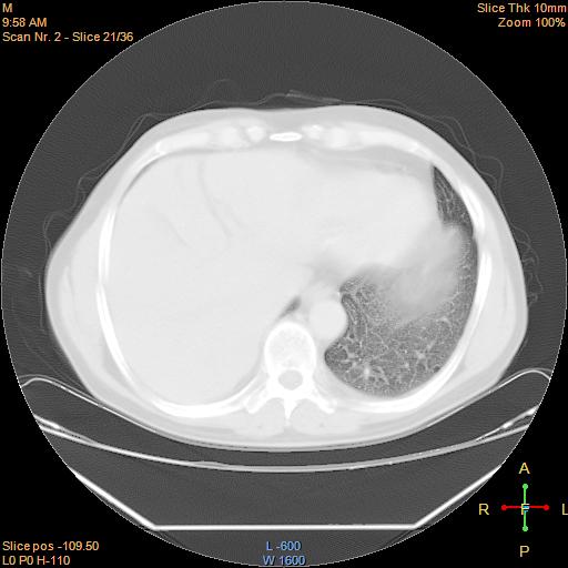 File:Bronchogenic carcinoma with superior vena caval invasion (Radiopaedia 22378-22406 lung window 18).jpg