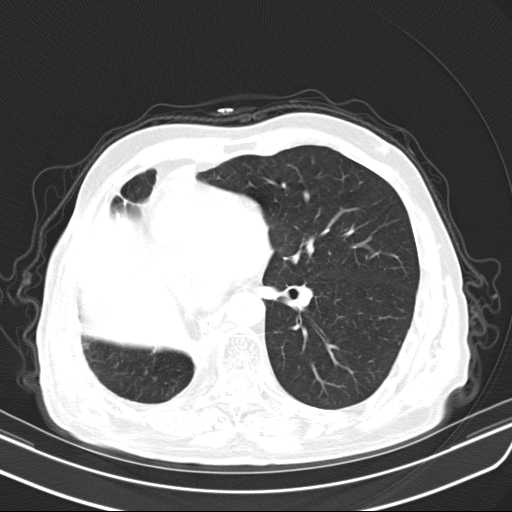 Bronchopleural fistula - postoperative complication (Radiopaedia 21020-20947 Axial lung window 33).jpg