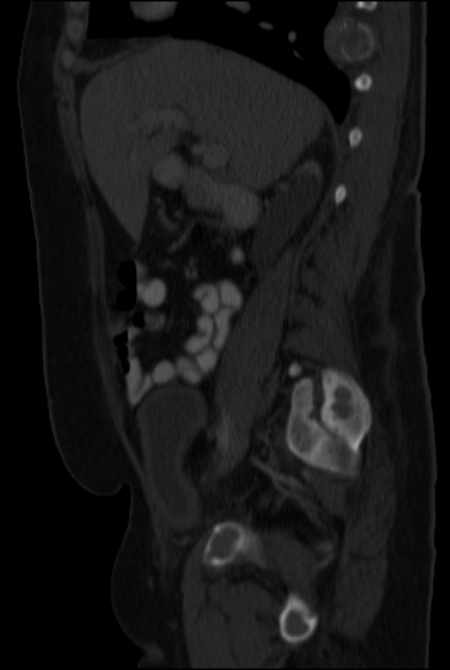 Brown tumors compressing the spinal cord (Radiopaedia 68442-77988 H 22).jpg