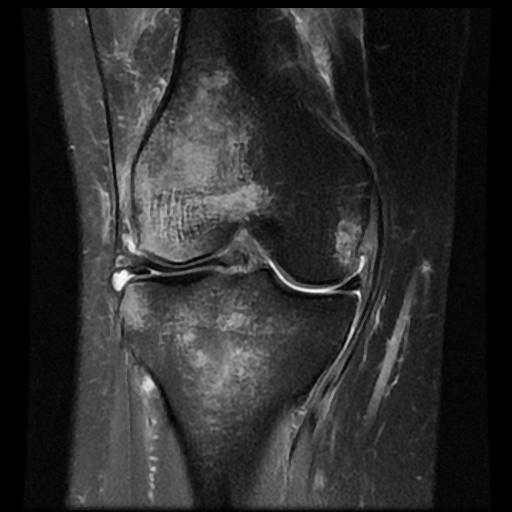 File:Bucket handle meniscus tear (Radiopaedia 56916-63751 Coronal PD fat sat 11).jpg