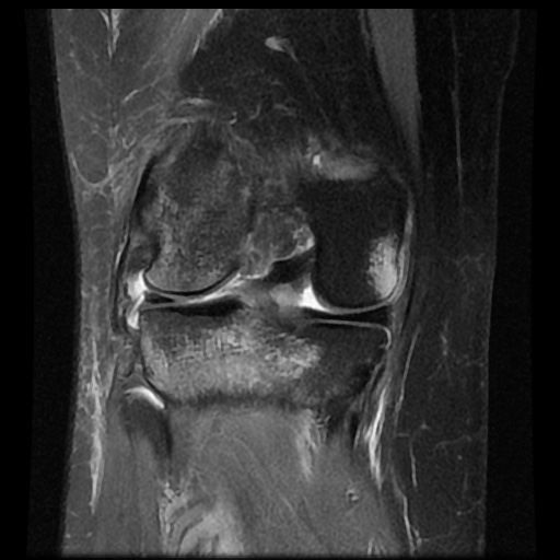 File:Bucket handle meniscus tear (Radiopaedia 56916-63751 Coronal PD fat sat 13).jpg