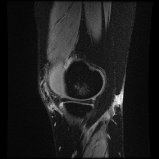 Bucket handle meniscus tear (Radiopaedia 56916-63751 H 71).jpg