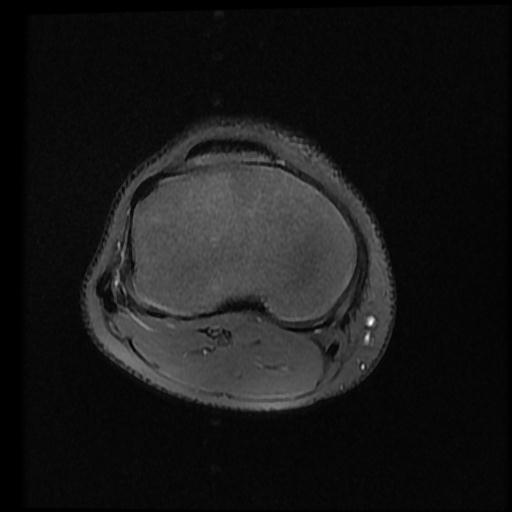 File:Bucket handle tear - lateral meniscus (Radiopaedia 72124-82634 Axial PD fat sat 12).jpg