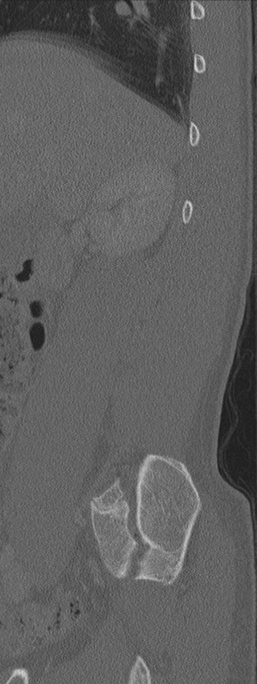 Burst fracture - T12 with conus compression (Radiopaedia 56825-63647 Sagittal bone window 75).png