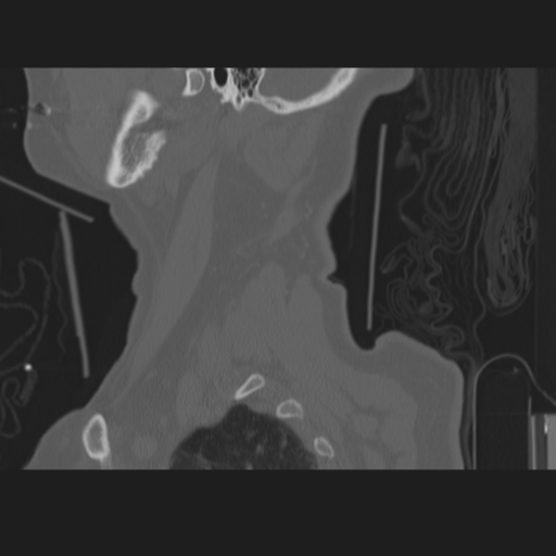 C2 fracture (Radiopaedia 34091-35341 Sagittal bone window 7).png