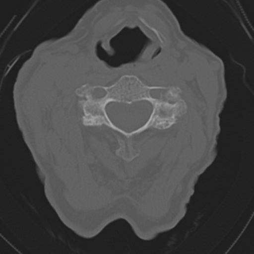 File:C2 fracture with vertebral artery dissection (Radiopaedia 37378-39199 Axial bone window 27).png