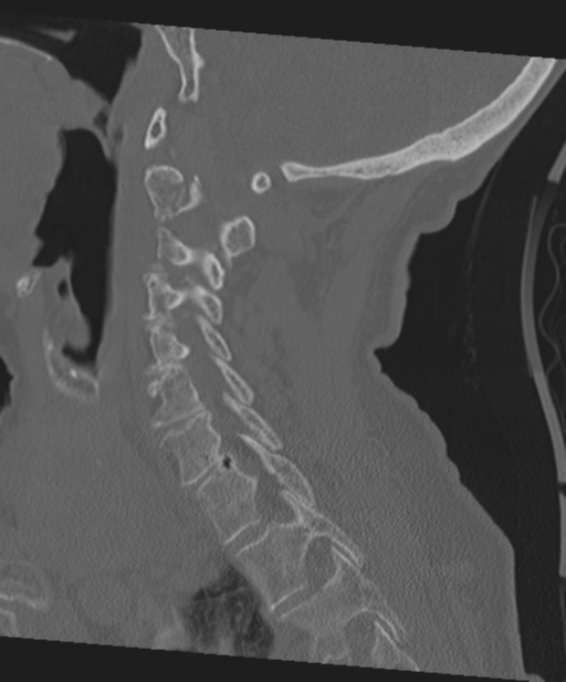 C2 fracture with vertebral artery dissection (Radiopaedia 37378-39199 Sagittal bone window 47).png