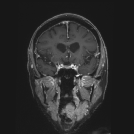 CNS lymphoma with steroid response (Radiopaedia 37980-39921 Coronal T1 C+ 14).png