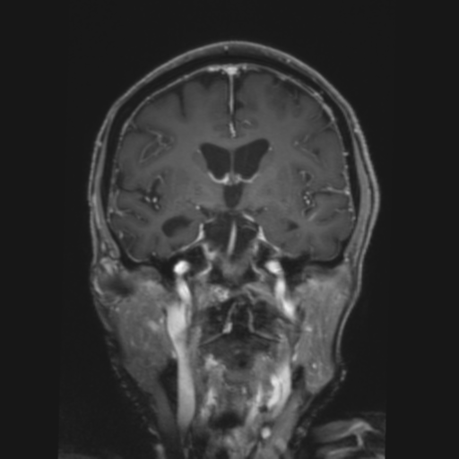 CNS lymphoma with steroid response (Radiopaedia 37980-39921 Coronal T1 C+ 21).png