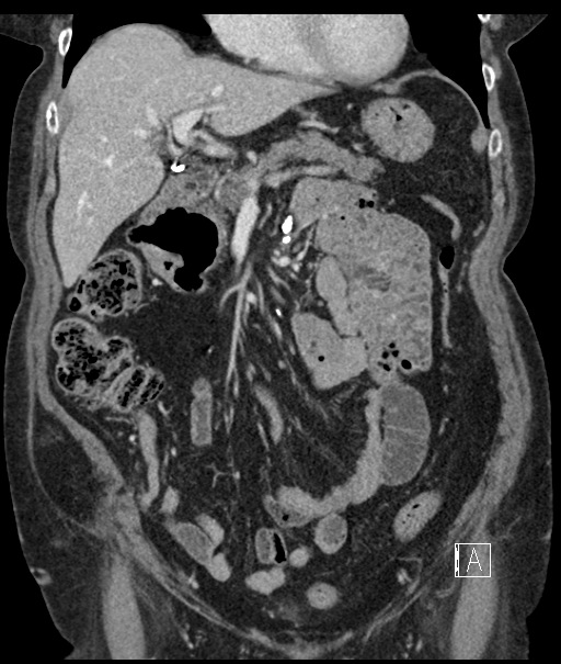 Calcified adrenal glands and Spigelian hernia (Radiopaedia 49741-54988 B 41).jpg