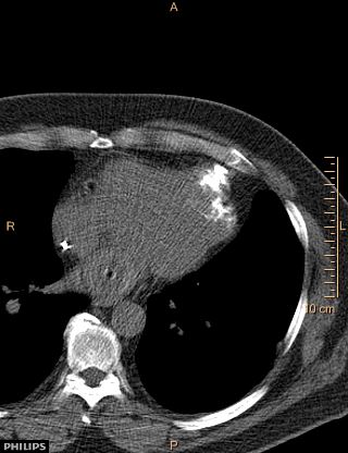 File:Calcified cardiac fibroma (Radiopaedia 39267-41519 Axial non-contrast 8).jpg
