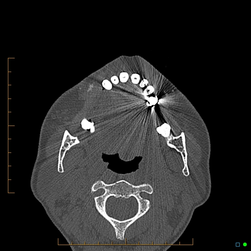 Calcified facial augmentation fillers (Radiopaedia 79514-92679 Axial bone window 102).jpg