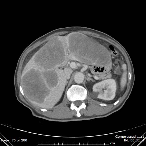 Calcified liver metastases (Radiopaedia 44699-48470 B 27).jpg
