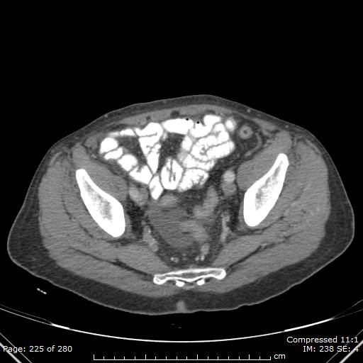 Calcified liver metastases (Radiopaedia 44699-48470 B 51).jpg