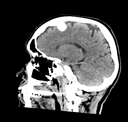 File:Calcified meningioma (Radiopaedia 74361-85243 D 7).jpg