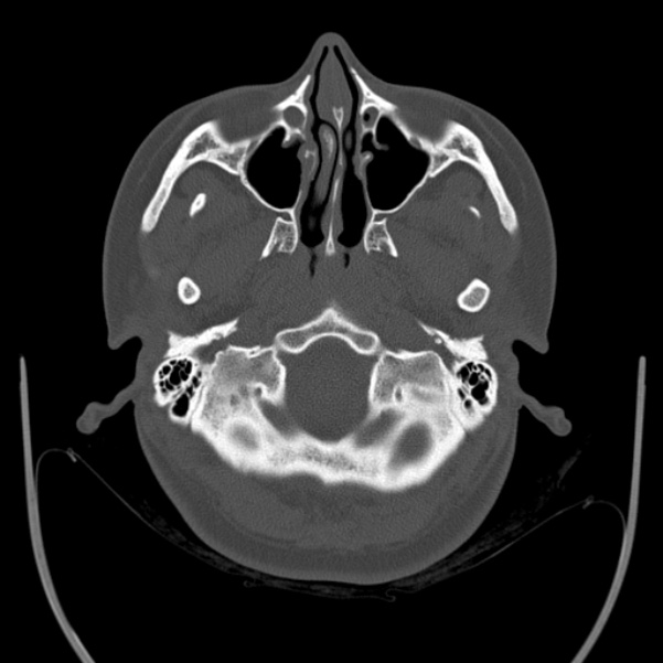 Calvarial osteoma (Radiopaedia 36520-38079 Axial bone window 15).jpg