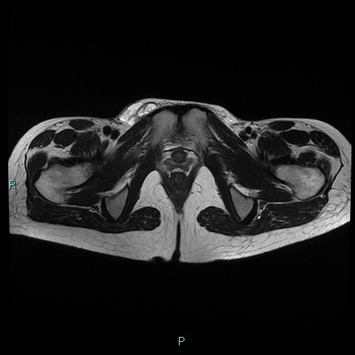 File:Canal of Nuck cyst (Radiopaedia 55074-61448 Axial T2 19).jpg