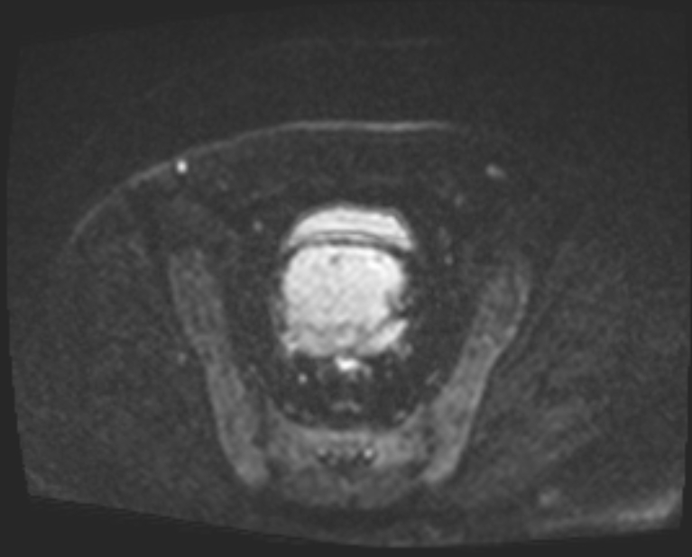 Cancer cervix - stage IIb (Radiopaedia 75411-86615 Axial DWI 46).jpg
