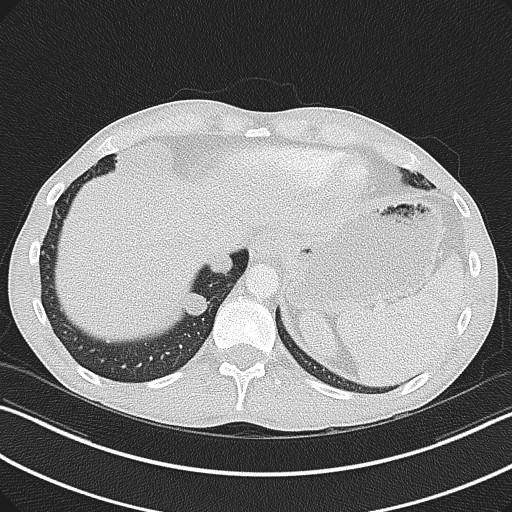 File:Cannonball metastases - testicular choriocarcinoma (Radiopaedia 84510-99891 Axial lung window 82).jpg