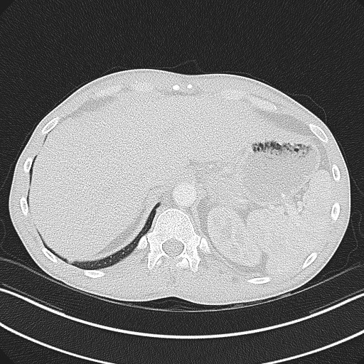 Cannonball metastases - testicular choriocarcinoma (Radiopaedia 84510-99891 Axial lung window 88).jpg