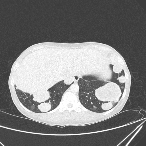 Canonball lung metastasis (Radiopaedia 77634-89837 Axial lung window 153).jpg