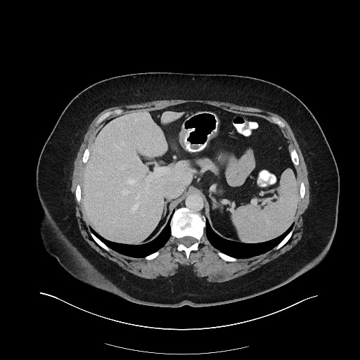 File:Carcinoid tumor - terminal ileum (Radiopaedia 60931-68739 A 33).jpg