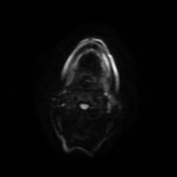 File:Carcinoma ex-pleomorphic adenoma of parotid (Radiopaedia 28383-28627 Ax DWI B-500 GE 46).jpg