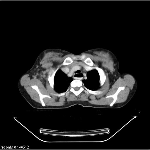 File:Carcinoma of esophagus (Radiopaedia 27356-27550 A 28).jpg