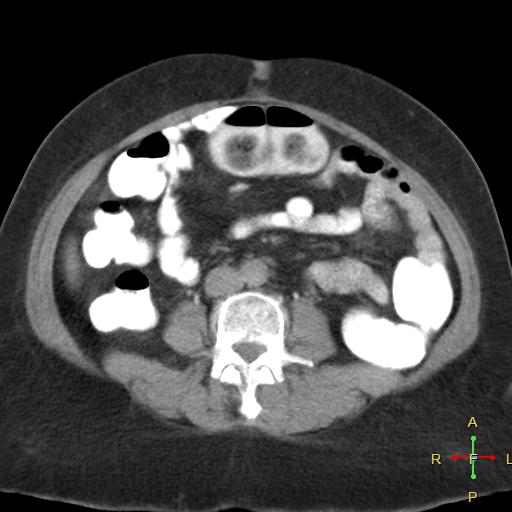File:Carcinoma of sigmoid colon (Radiopaedia 23071-23100 C+ delayed 12).jpg