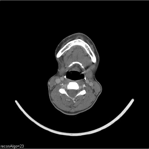 File:Carcinoma of the maxillary antrum (Radiopaedia 53805-59888 Axial C+ delayed 26).jpg
