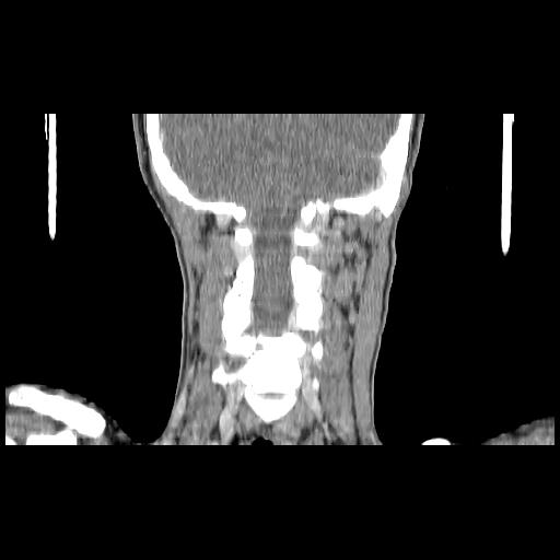 Carcinoma of the maxillary antrum (Radiopaedia 53805-59888 Coronal C+ delayed 123).jpg