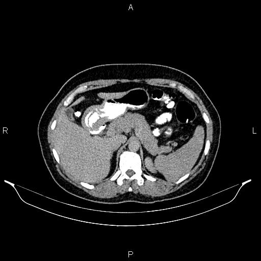 File:Carcinoma of uterine cervix (Radiopaedia 85861-101700 Axial C+ delayed 11).jpg