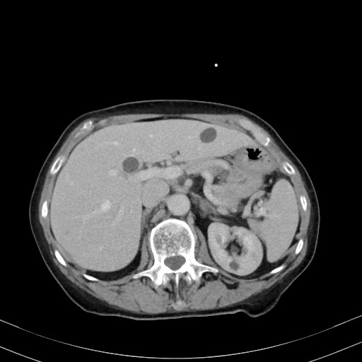 Carcinosarcoma (Radiopaedia 70401-80503 A 18).jpg