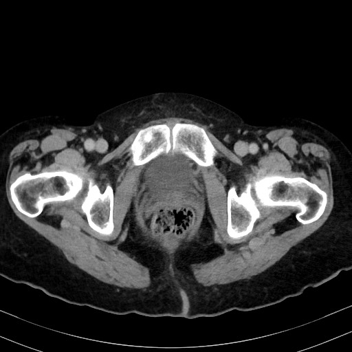Carcinosarcoma (Radiopaedia 70401-80503 A 68).jpg