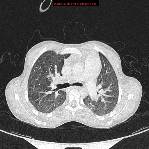 File:Cardiac bronchus (Radiopaedia 14059-13899 A 9).jpg