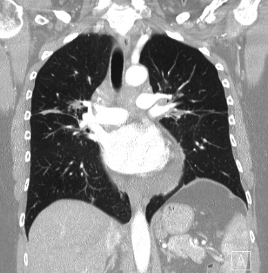 Cardiac sarcoidosis (Radiopaedia 74548-85534 Coronal lung window 35).jpg