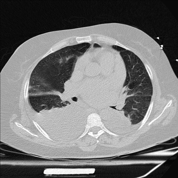 Cardiogenic pulmonary edema (Radiopaedia 29213-29609 Axial lung window 47).jpg