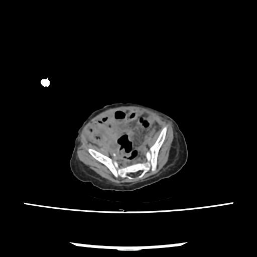 Caroli disease with autosomal recessive polycystic kidney disease (ARPKD) (Radiopaedia 89651-106703 E 195).jpg