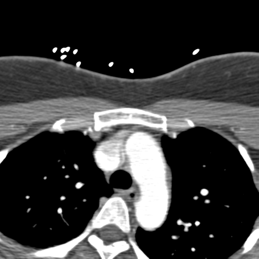 Carotico ophthalmic aneurysm (Radiopaedia 42916-46148 A 106).png