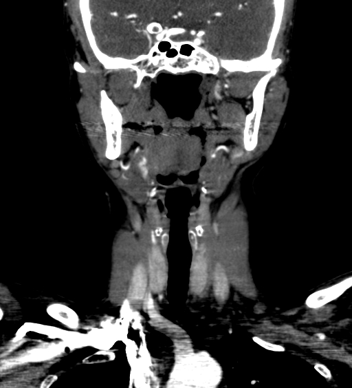 File:Carotid body tumor (Radiopaedia 39845-42300 C 1).jpg