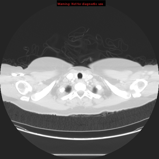 Carotid body tumor with lung metastases (Radiopaedia 9301-48390 Axial lung window 10).jpg