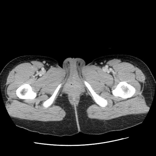 File:Castleman disease with fibrous pseudotumor in the abdomen (Radiopaedia 77296-89373 A 140).jpg