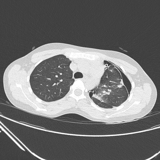 File:Catamenial pneumothorax (Radiopaedia 27946-28197 lung window 56).jpg