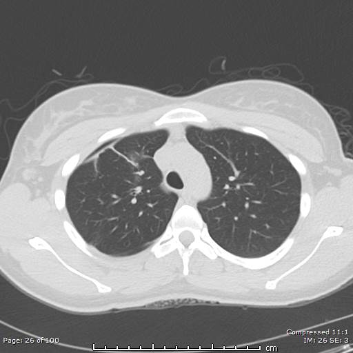 Catamenial pneumothorax (Radiopaedia 54382-60600 Axial non-contrast 26).jpg
