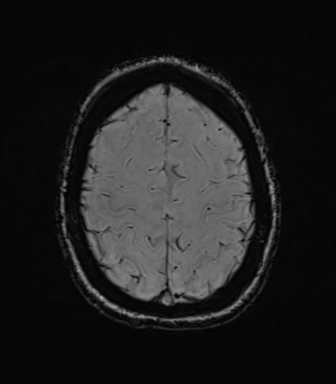 File:Cavernoma with bleed - midbrain (Radiopaedia 54546-60773 Axial SWI 39).png