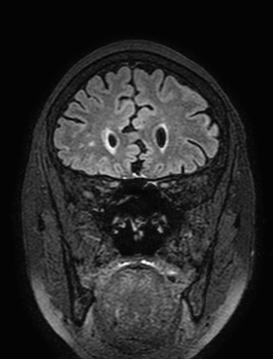 Cavernous hemangioma of the cerebellar falx (Radiopaedia 73025-83724 Coronal FLAIR 92).jpg