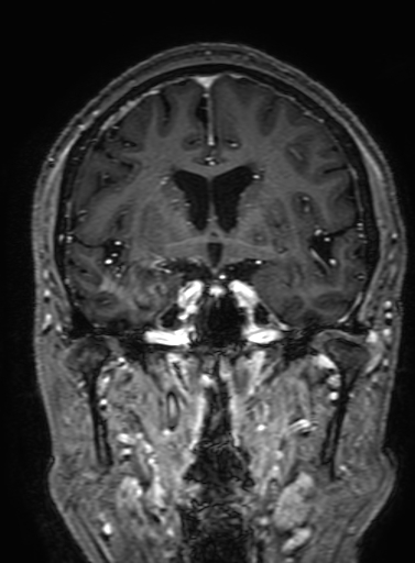 Cavernous hemangioma of the cerebellar falx (Radiopaedia 73025-83724 Coronal T1 C+ 163).jpg