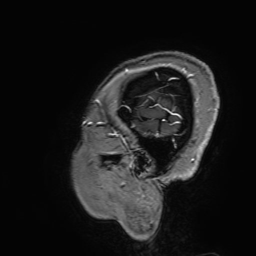 Cavernous hemangioma of the cerebellar falx (Radiopaedia 73025-83724 Sagittal T1 C+ 198).jpg
