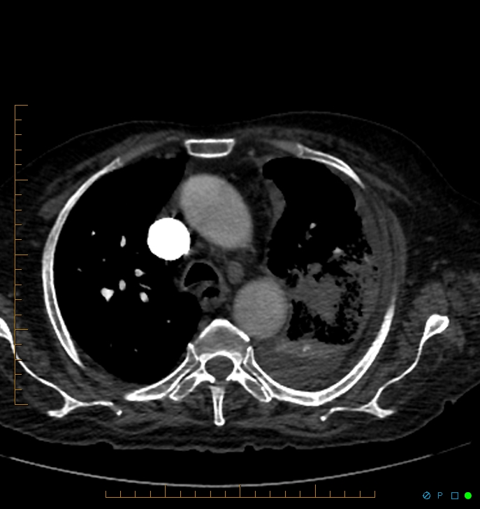 Cavitating pulmonary infarction (Radiopaedia 54634-60849 Axial C+ CTPA 18).jpg